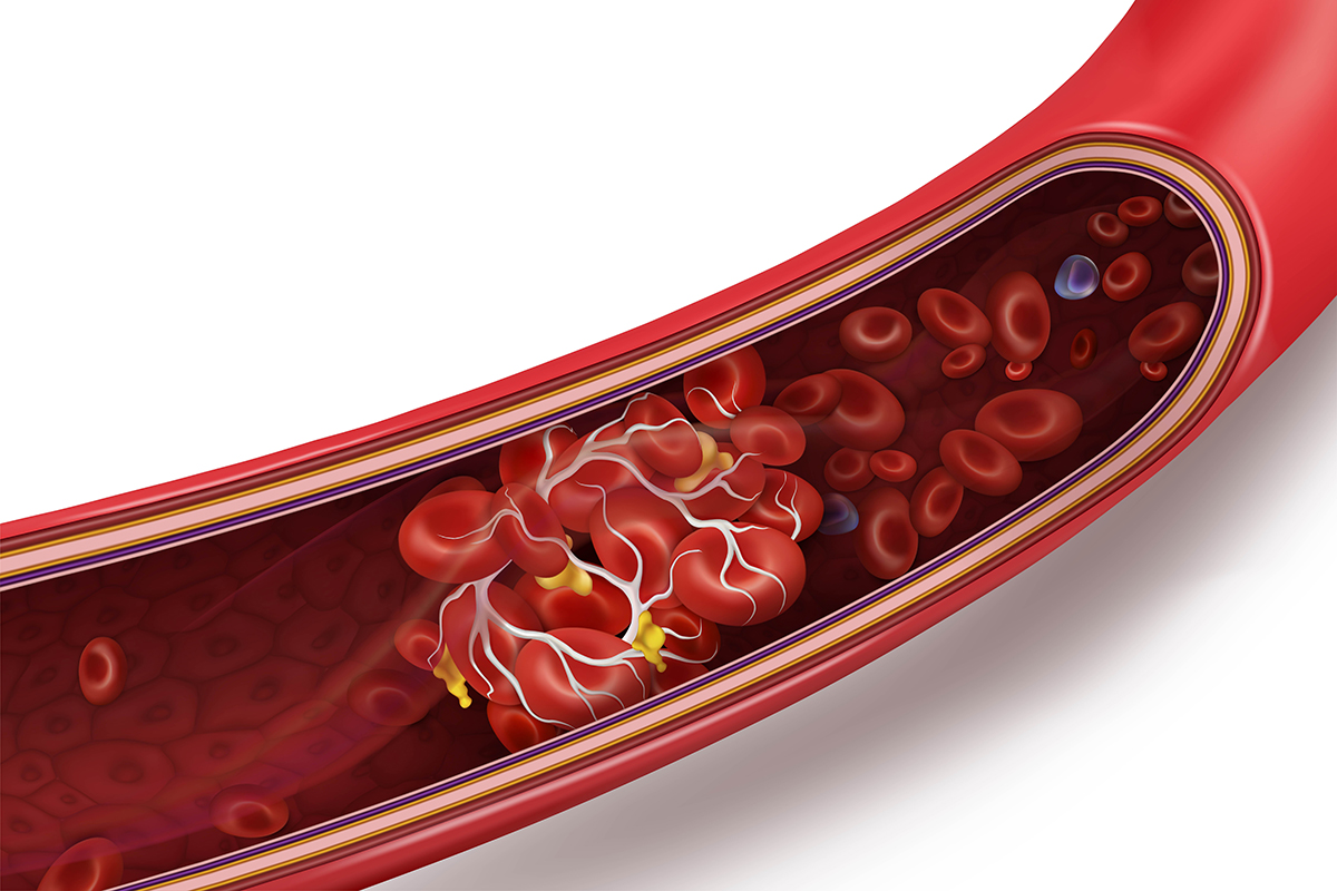 Blood Clot Symptoms: How Do You Know if You Have One?