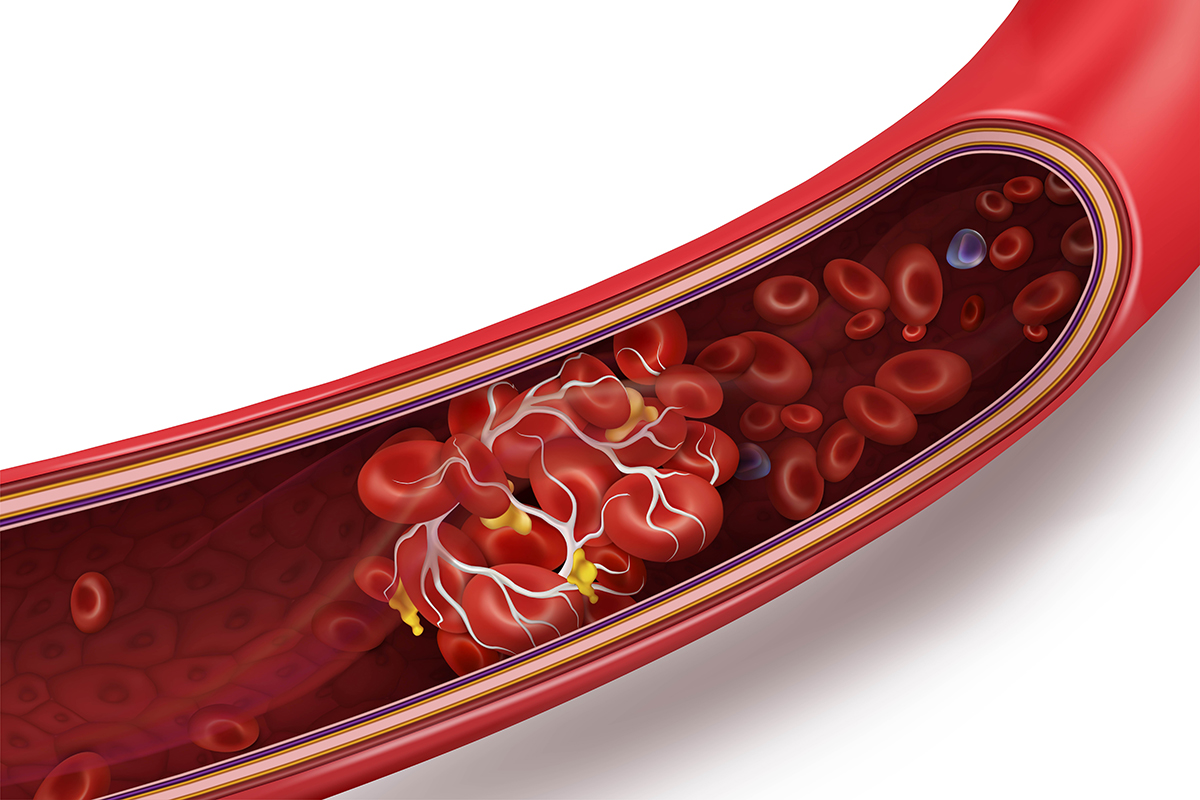 Blood Clot in the Hand: Symptoms, Signs & Treatment - Lesson