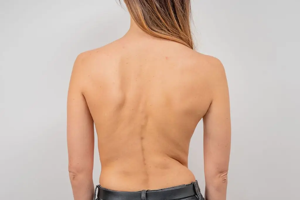 Adult Scoliosis