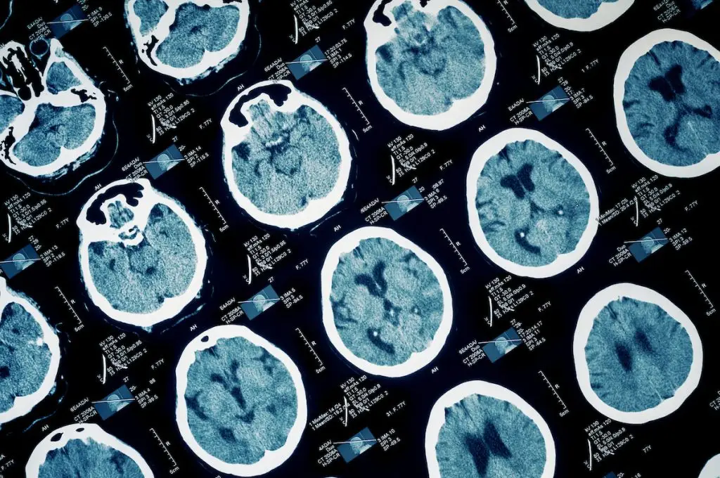 MRI images of the human brain