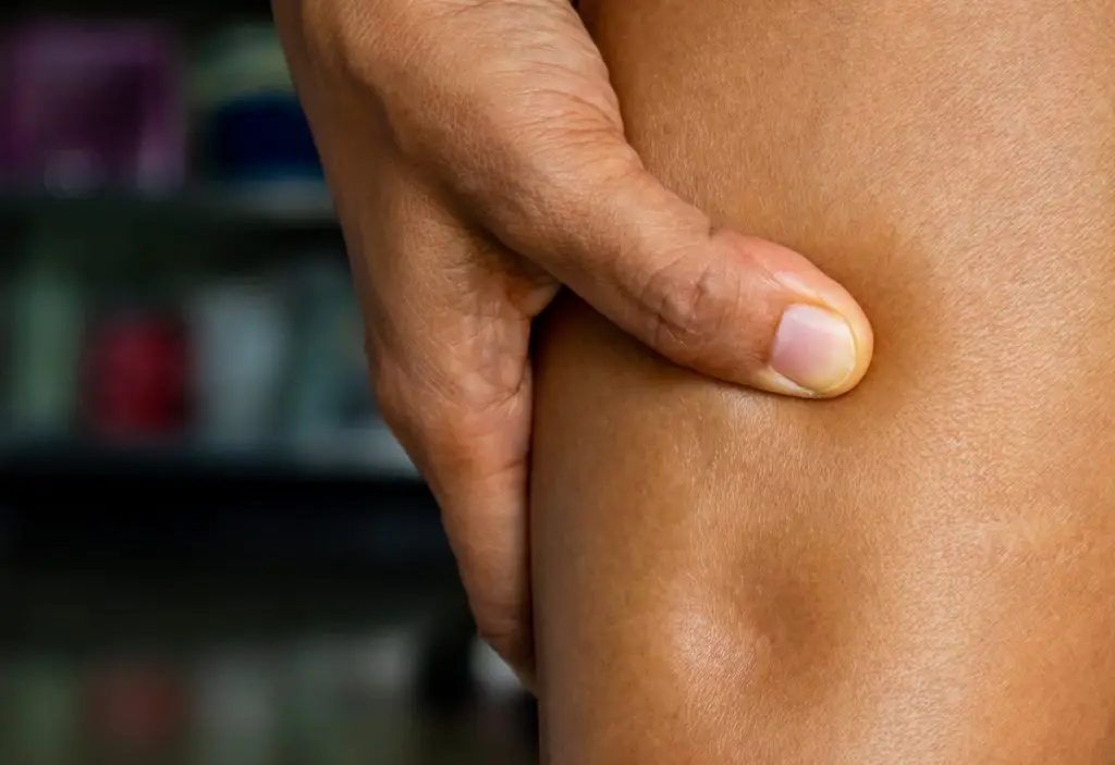 How to Tell if You Have Edema
