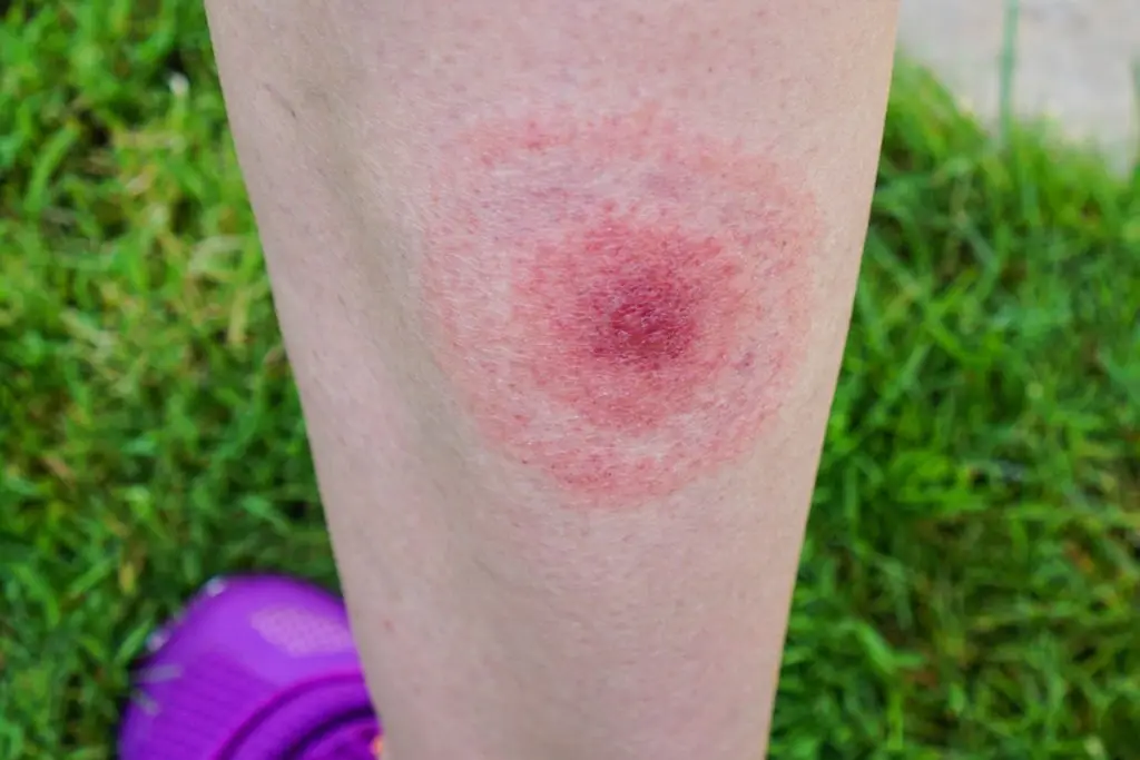 Diagnosing and Treating Lyme Disease