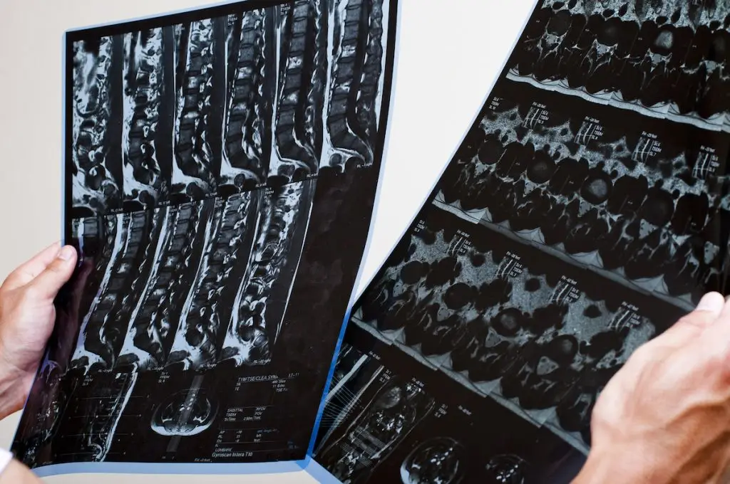 Doctor holding MRI scans of the spine
